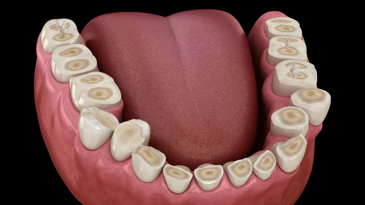 Erosi Gigi: Penyebab, Gejala, Pengobatan, dan Pencegahan